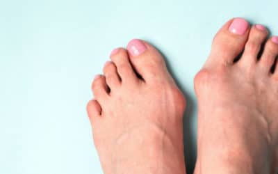 A Tale of Two Bunions