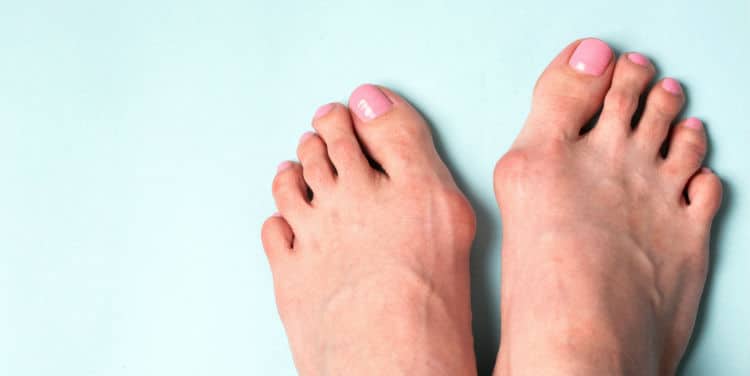 A Tale of Two Bunions
