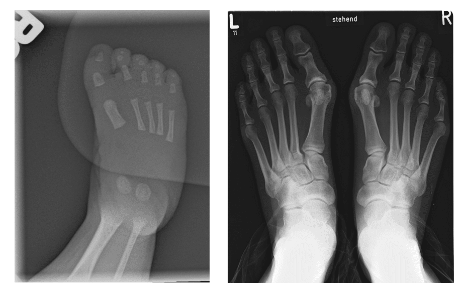X-ray child vs adult foot