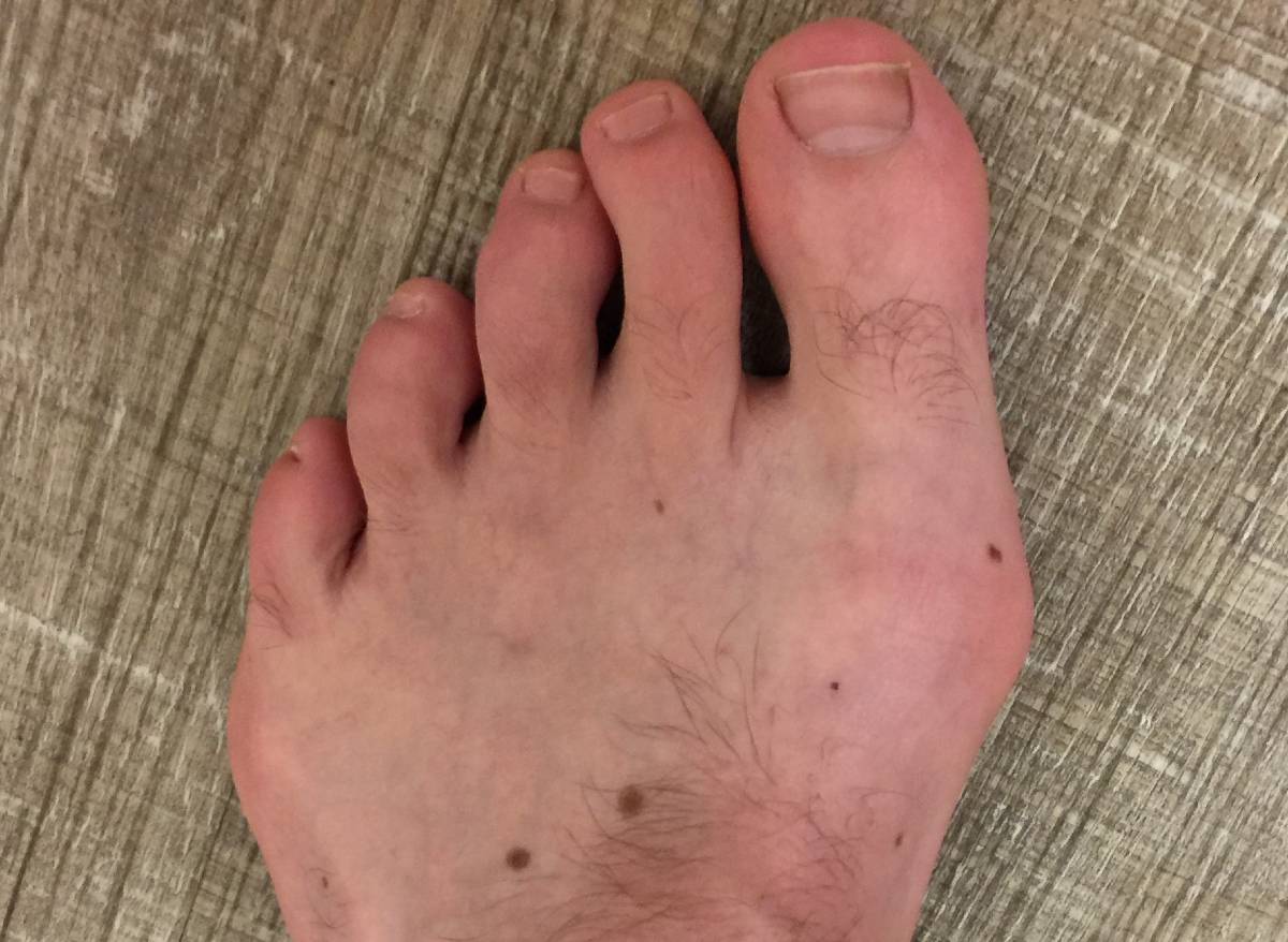 Bunion and Tailor's Bunion