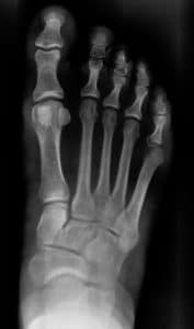 adult foot x-ray from top