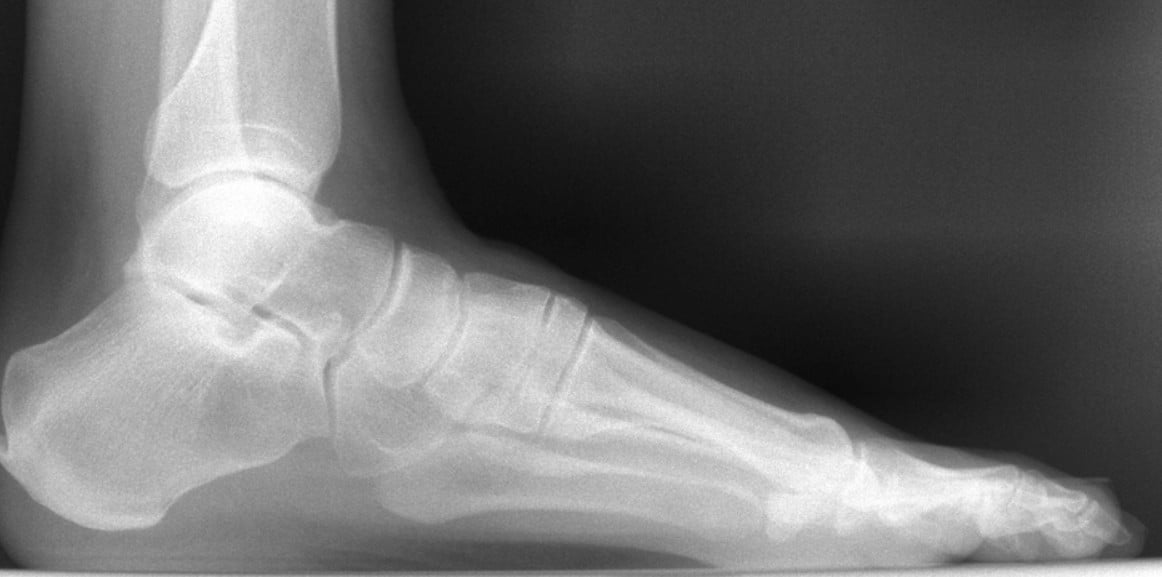 adult foot x-ray from side