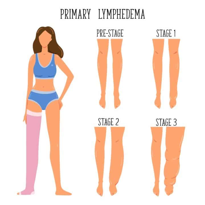 lymphedema stage diagram