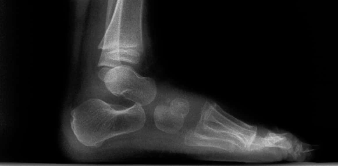 child foot x-ray from side