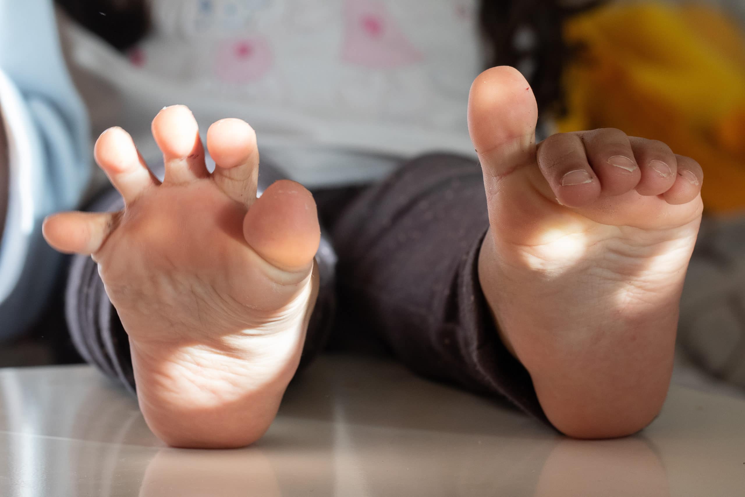 Big toe varism in the feet of a child