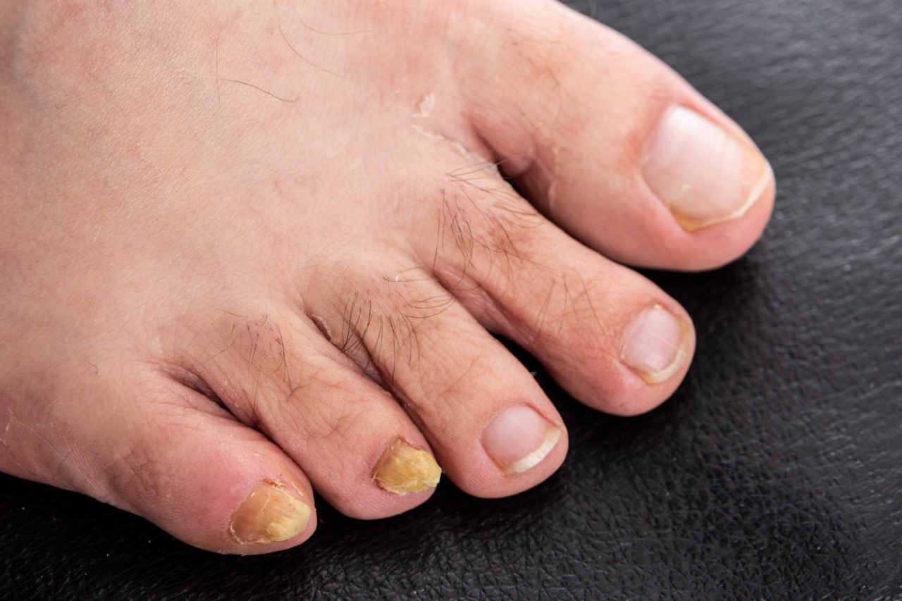 Close-up with male fungal disease male toenails
