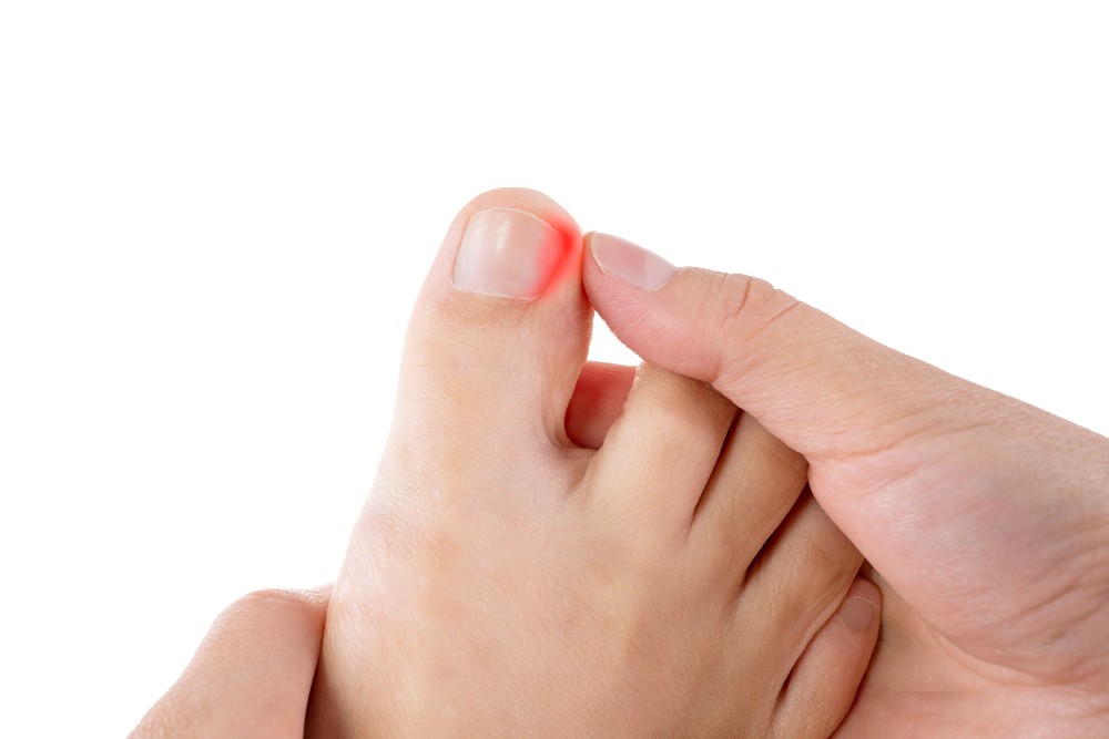 Big toe pain caused-by an ingrown toenail