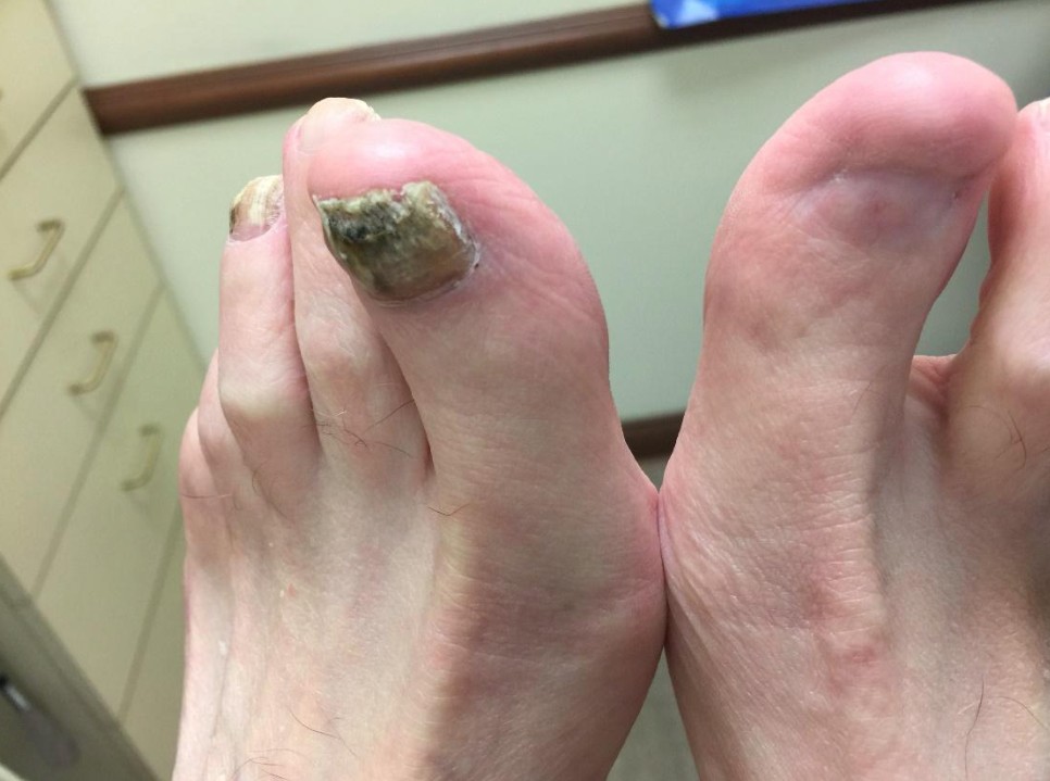 Fungal nails with one toenail removed