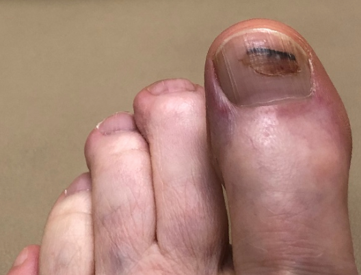toenail after 6 months of treatment
