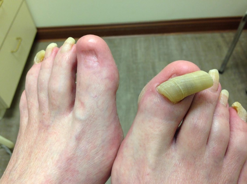 Thick fungal nails with one toenail removed